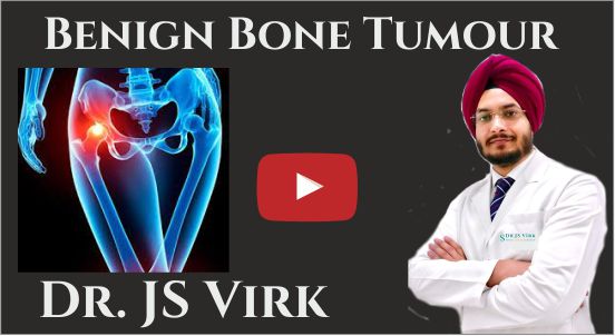 Benign Bone Tumour Surgery, Dr JS Virk Best Bone Tumour Surgeon, Best Bone Tumour Surgeon in Punjab, Bone Tumour Treatment in India