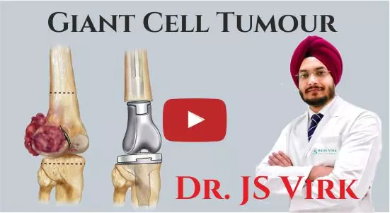 Giant Cell Tumour Surgey in Punjab, Dr J S Virk, Best Bone Cancer Surgeon, Best Doctor for Giant Cell Tumour, Cost of Treatment for GCT in India, Best Surgeon for Giant Cell Tumour at Paras Hospital Punjab