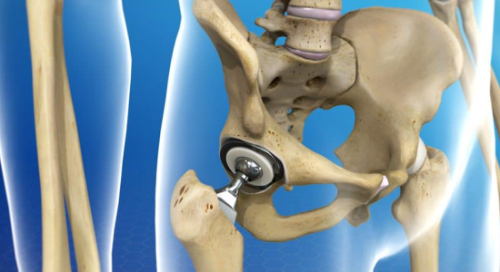 Hip Replacement Surgery in Punjab, Dr J S Virk, Best Orthopaedic Surgeon in Punjab, Best Hip Joint Specialist in Punjab, Best Surgeon for AVN of Hip, Cost of Hip Replacement Surgery in Mohali
